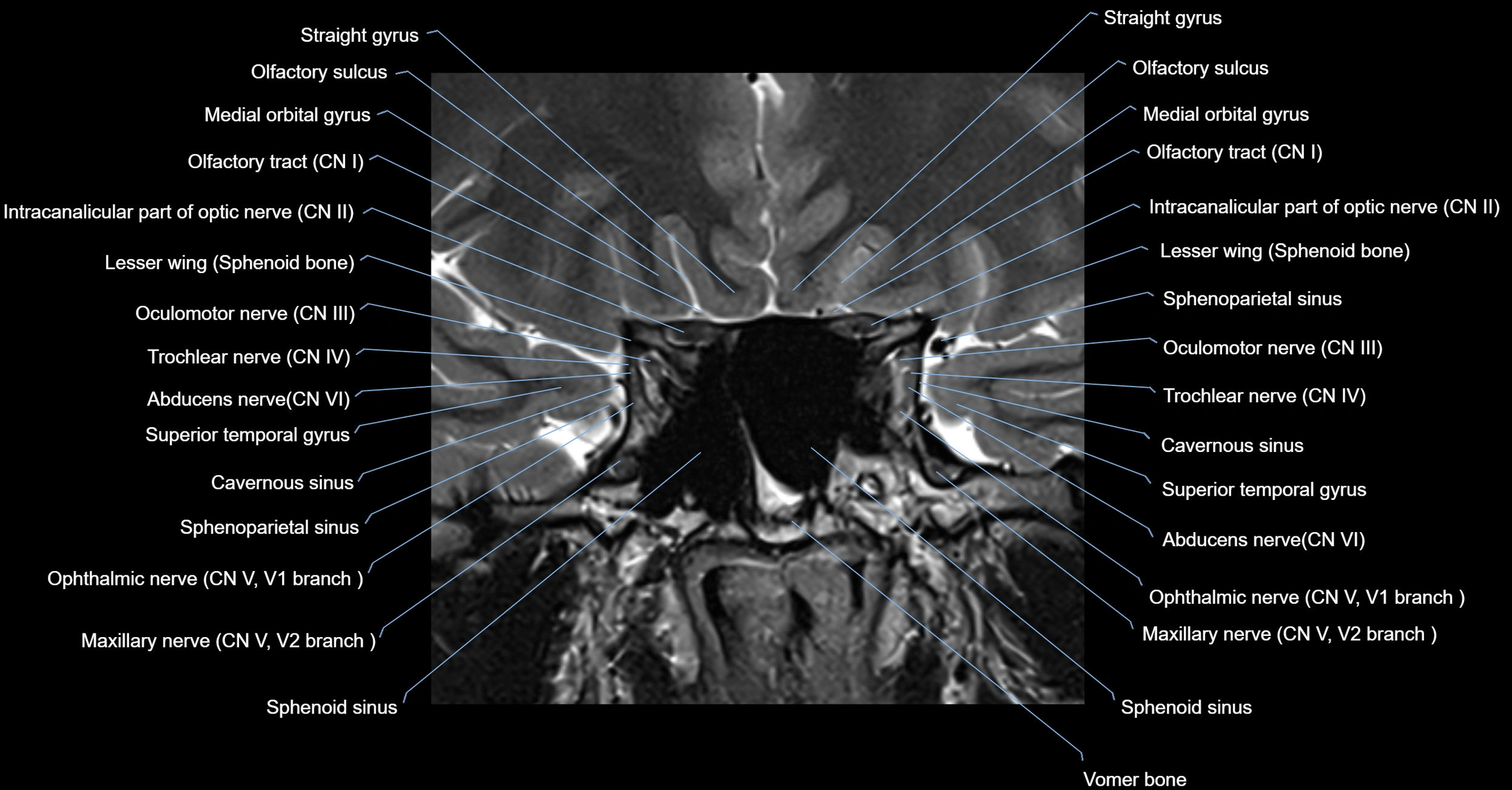 MRI cavernous sinus coronal cross sectional 3T anatomy image-img-00001-00004.webp